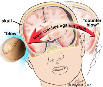 brain concussion