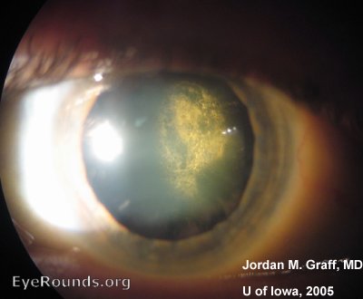 capsular cataract
