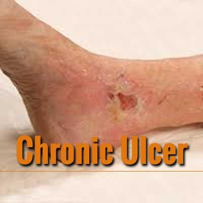 chronic ulcer