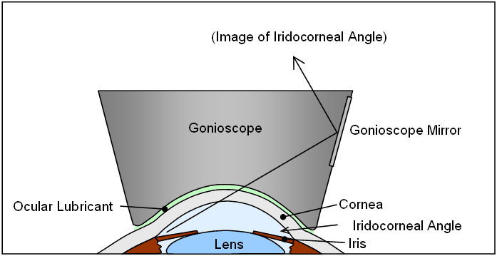 gonioscope