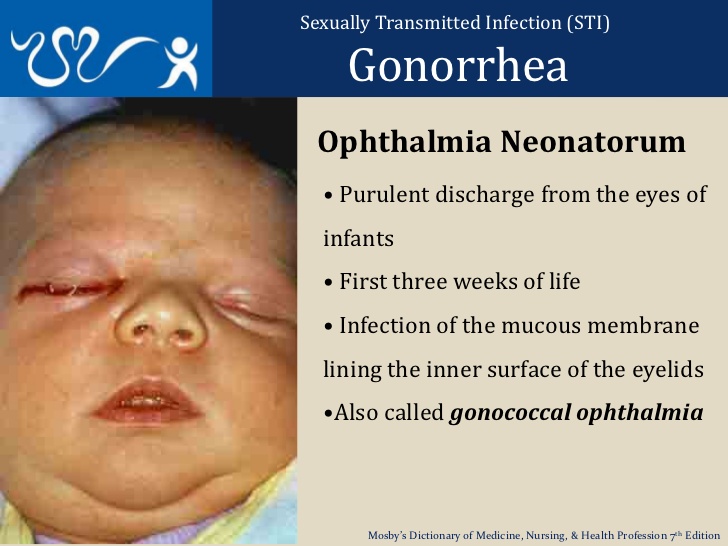 gonorrheal ophthalmia