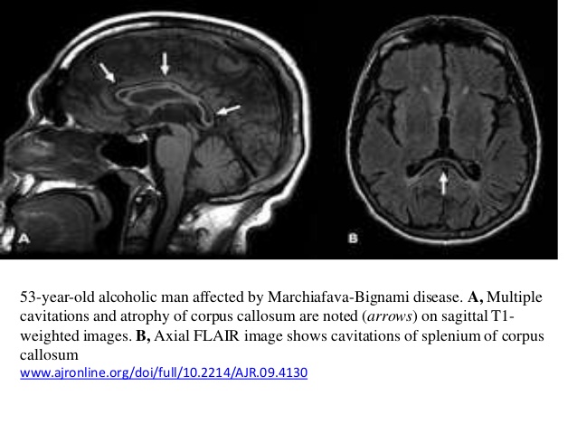 marchiafava-bignami disease