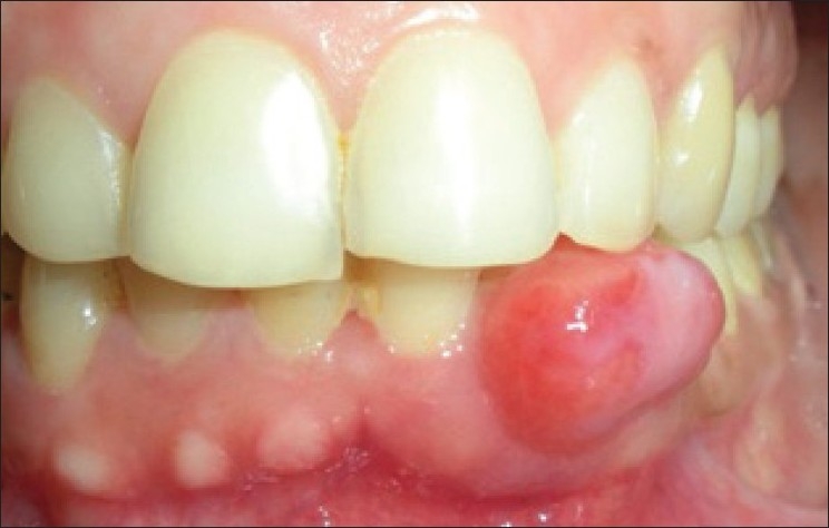 peripheral ossifying fibroma