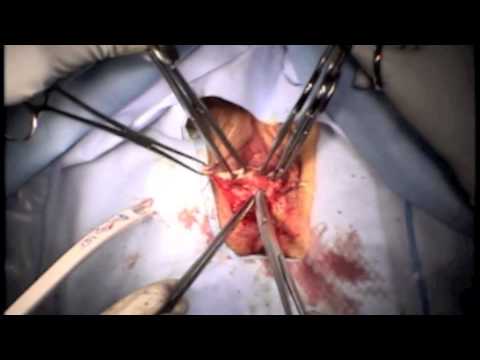 peritoneoplasty
