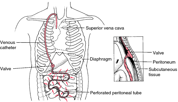 peritoneovenous shunt
