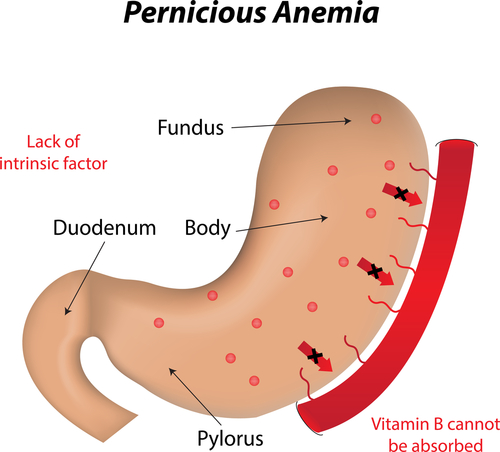 pernicious anaemia