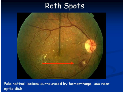 Roth’s spots