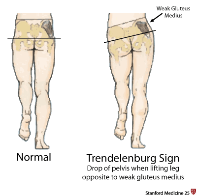 trendelenburg's sign