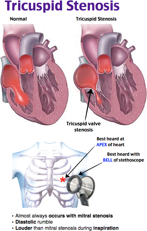 tricuspid stenosis