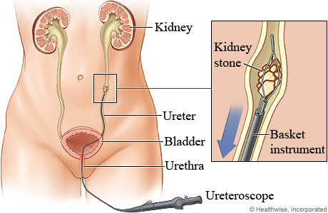 uteroscopy
