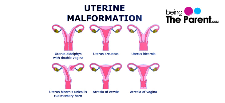 uterus didelphys