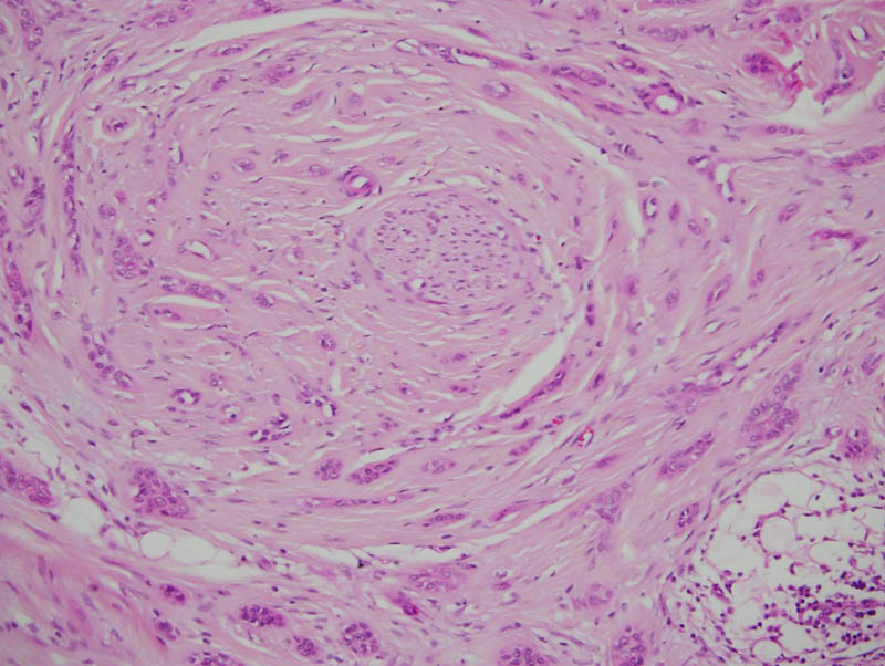 Microcystic adnexal carcinoma, microscopic exam. Atypical disorganized  collection of cells forming tubular structures. (H&E, X40)