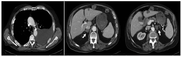 Figura 1. a) TAC torácico: derrame pleural izquierdo y calcificación  pleural derecha; b) TAC abdominal: hipertrofia glándulas suprarrenales  (flechas).