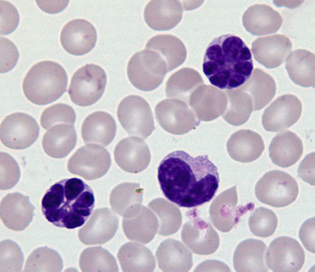Adult T-Cell Leukemia / Lymphoma (ATLL)