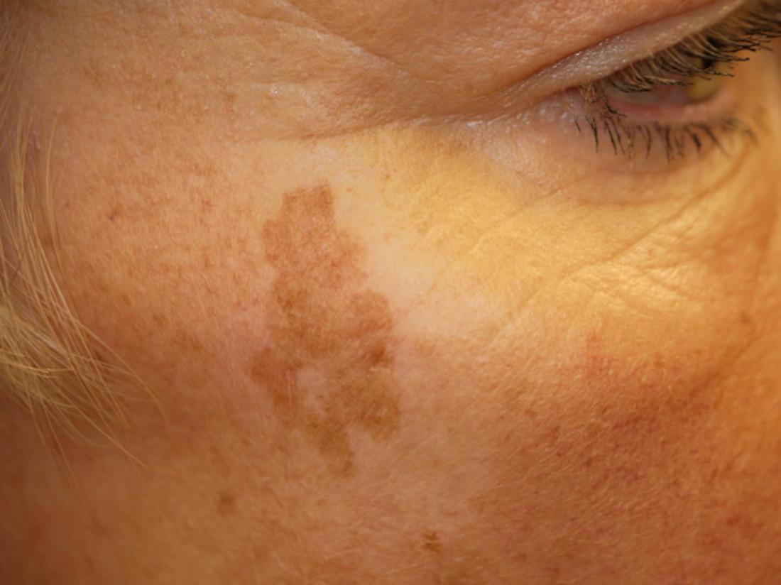 Age spot or liver spot on the face Image credit: DermNet,
