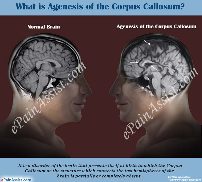 What is Agenesis of the Corpus Callosum?