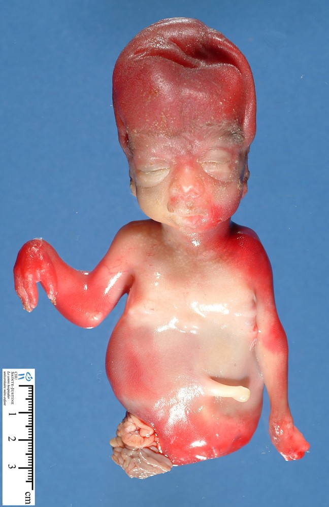 Pelvic agenesis in caudal dysplasia (maternal diabetes, fetus 19 weeks) (.