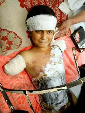 injured-iraqi-boy
