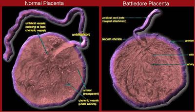 Normal placenta vs. battledore placenta