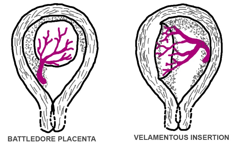 battledore placenta pictures