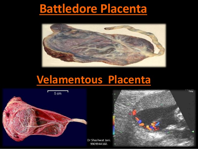 Battledore Placenta