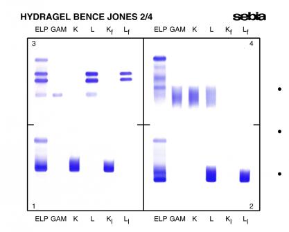 A recent development on GELSCAN provides the ability to quantify the  monoclonal protein from the ELP track.