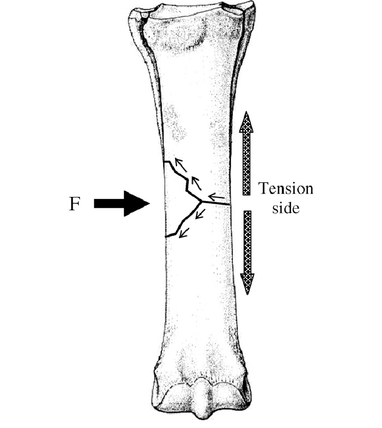 Lateral impact loading of a long bone causes bending. The fracture starts  at the tension side (away from the site of impact) and progresses across  the bone