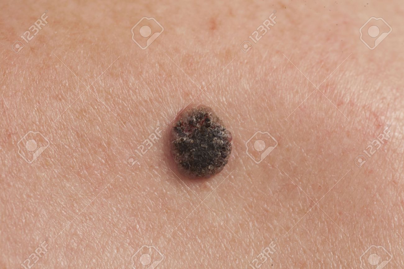 keratinizing squamous cell carcinoma of the skin on the back of an elderly  man Stock Photo