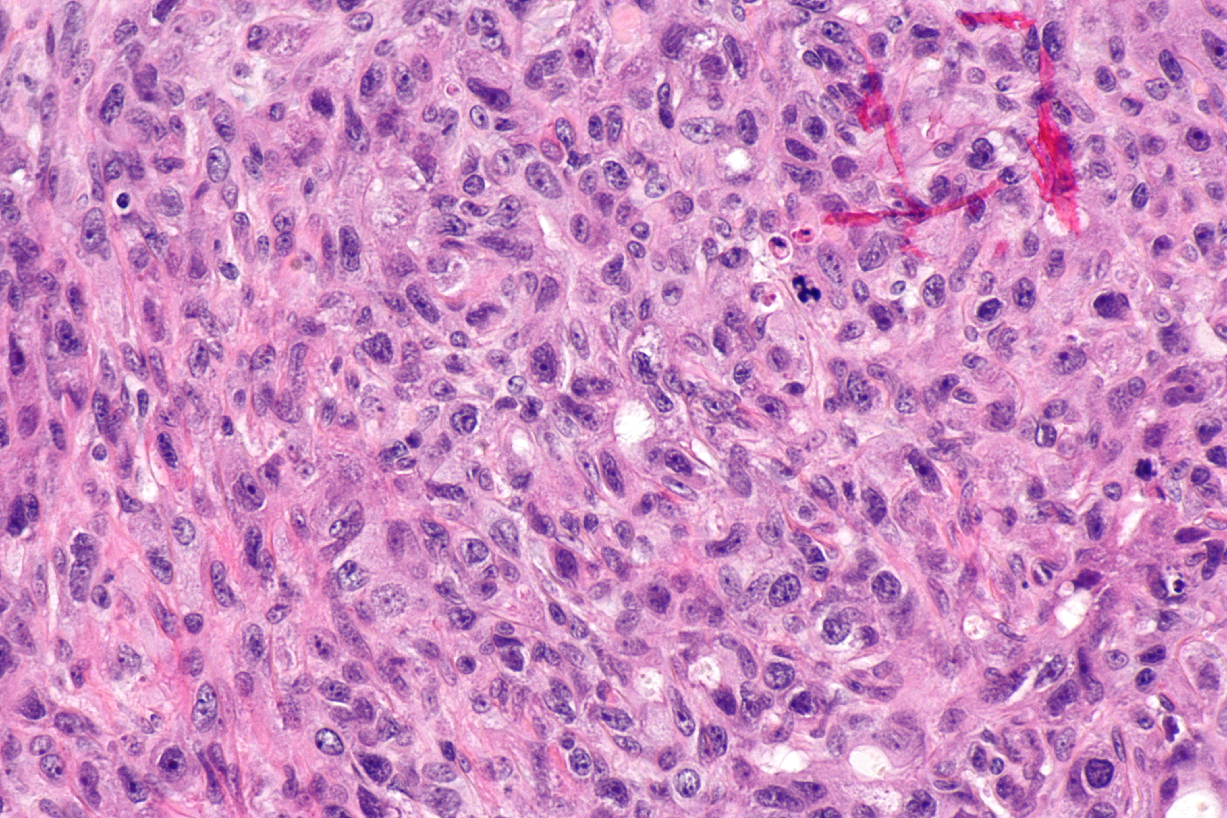 File:Carcinoma ex pleomorphic adenoma -- high mag.jpg