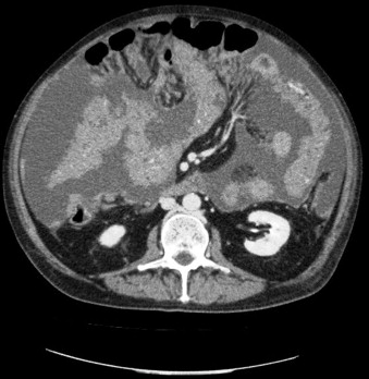 Peritoneal carcinosis with massive ascites.