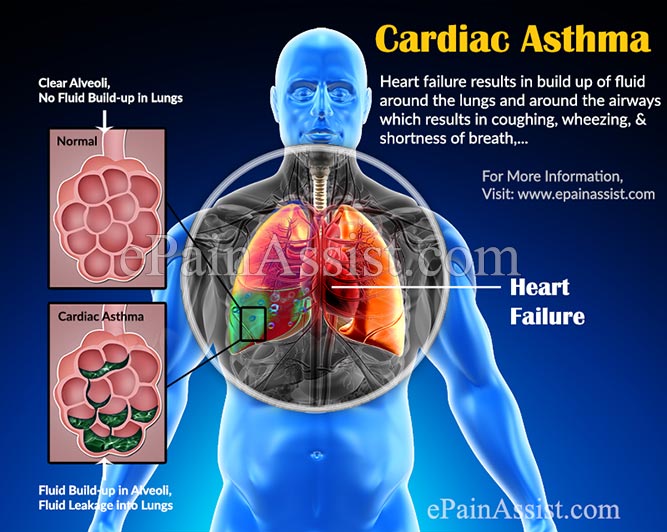 What is Cardiac Asthma?