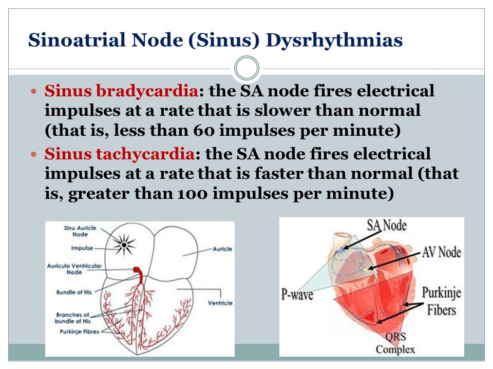 Sinoatrial Node (Sinus) Dysrhythmias