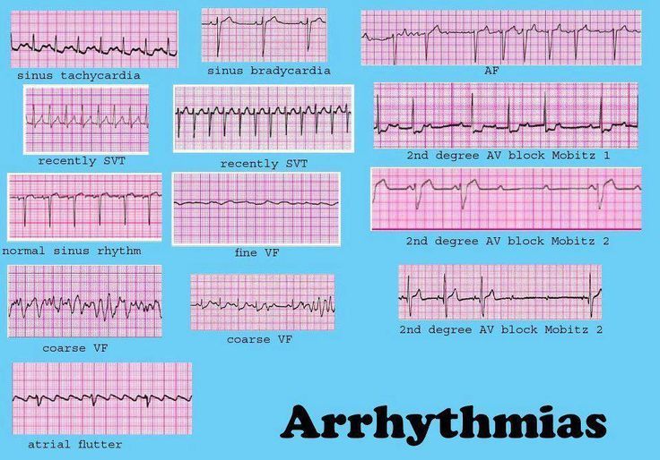 Dysrhythmia Cheat Sheet | Cardiac Dysrrhythmia (aka Arrhythmia And  Irregular Heartbeat :