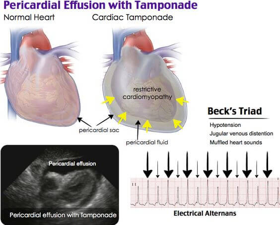 cardiac tamponade