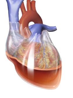 Hemopericardium, wherein the pericardium becomes filled with blood, is one  cause of cardiac tamponade.