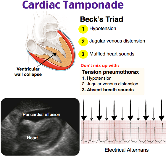 Teaching Image: Cardiac Tamponade