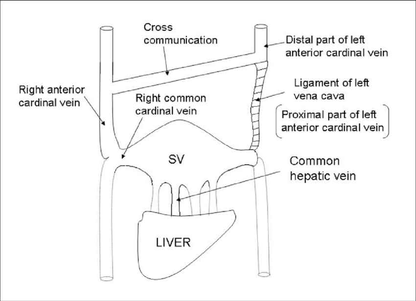Diagram shows the changes in the left anterior cardinal vein. SV: Sinus  venosus.