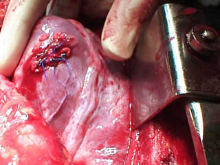 Cardiorrhaphy - Left ventricle pledget repair