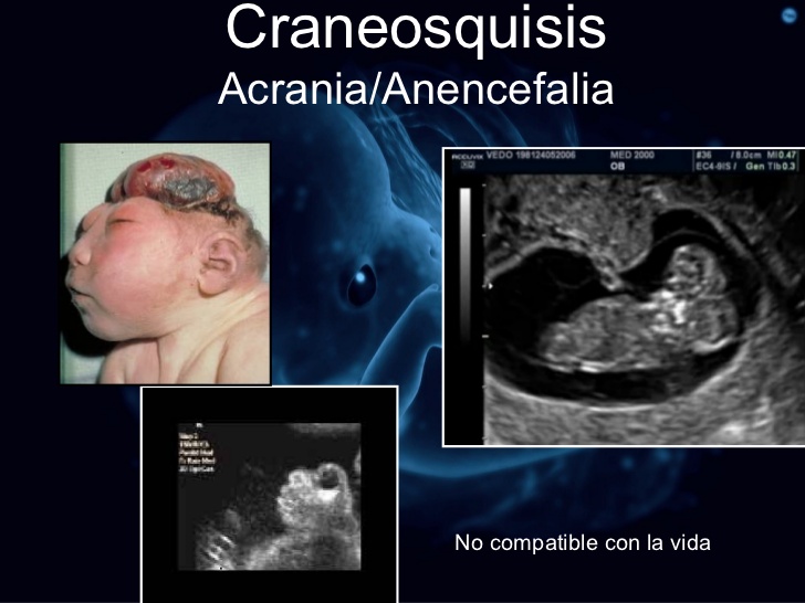 Craneosquisis EncefaloceleDiagnóstico