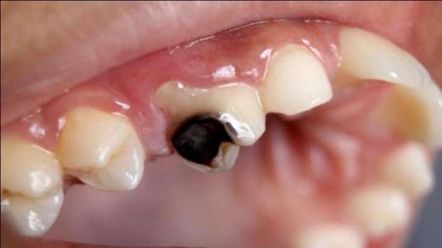 Salud Bucodental Caries dental