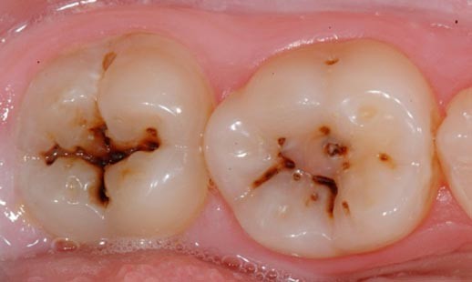 Caries Dentales: Causas, Desarrollo y Tratamiento