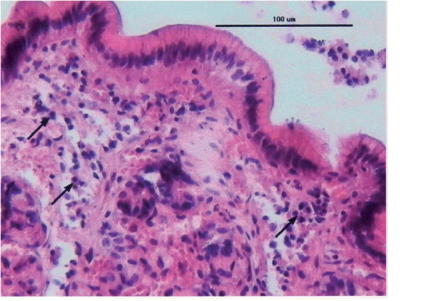 Chronic catarrhal inflammation of gastric mucosa. Intense plasmacytic  (arrows) and lymphocytic infiltration.