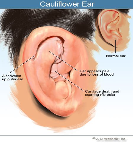Picture of a normal ear, and cauliflower ear