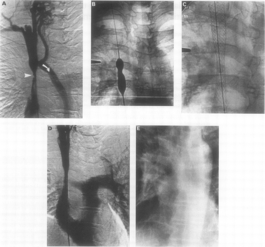 (A) Digital subtraction superior vena cavogram showing low stricture in  superior vena cava (arrowhead) with collateral venous drainage in the  superior