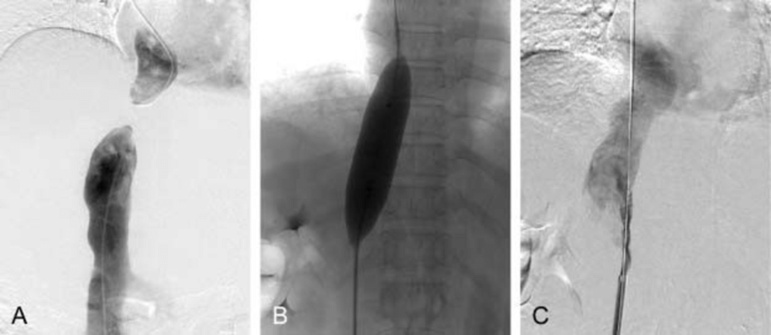 A. Inferior vena cavogram via both the jugular approach and the femoral  approach reveal complete obstruction of the intrahepatic IVC, which  confirmed the