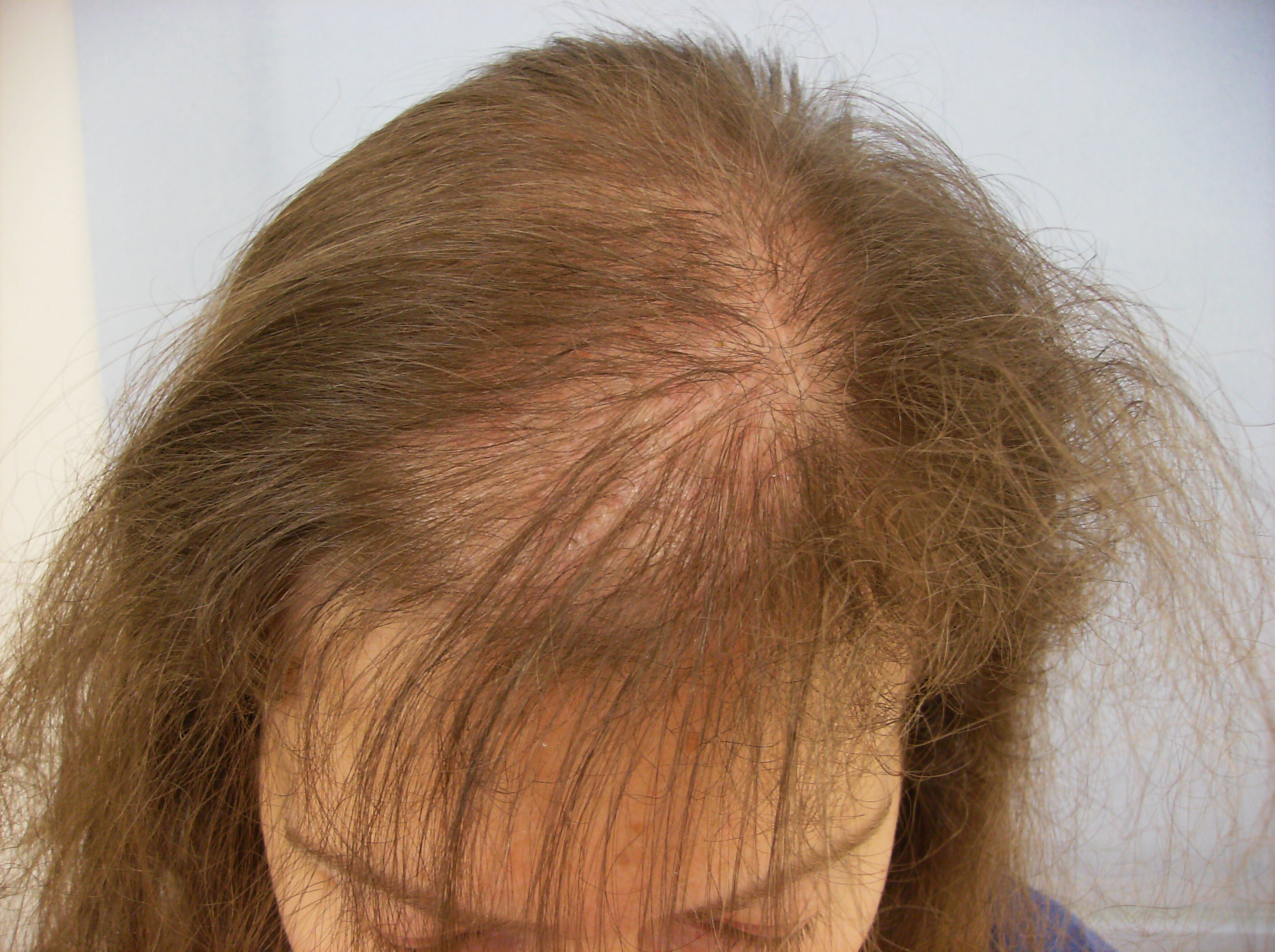 Telogen Defluvium (Female Alopecia)