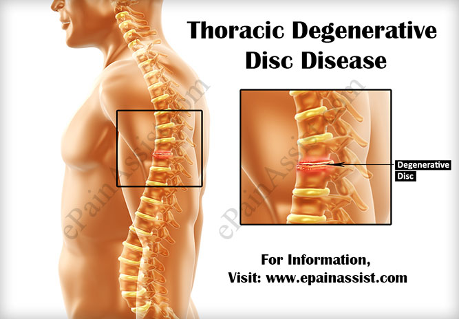 The Thoracic Spine & its Discs