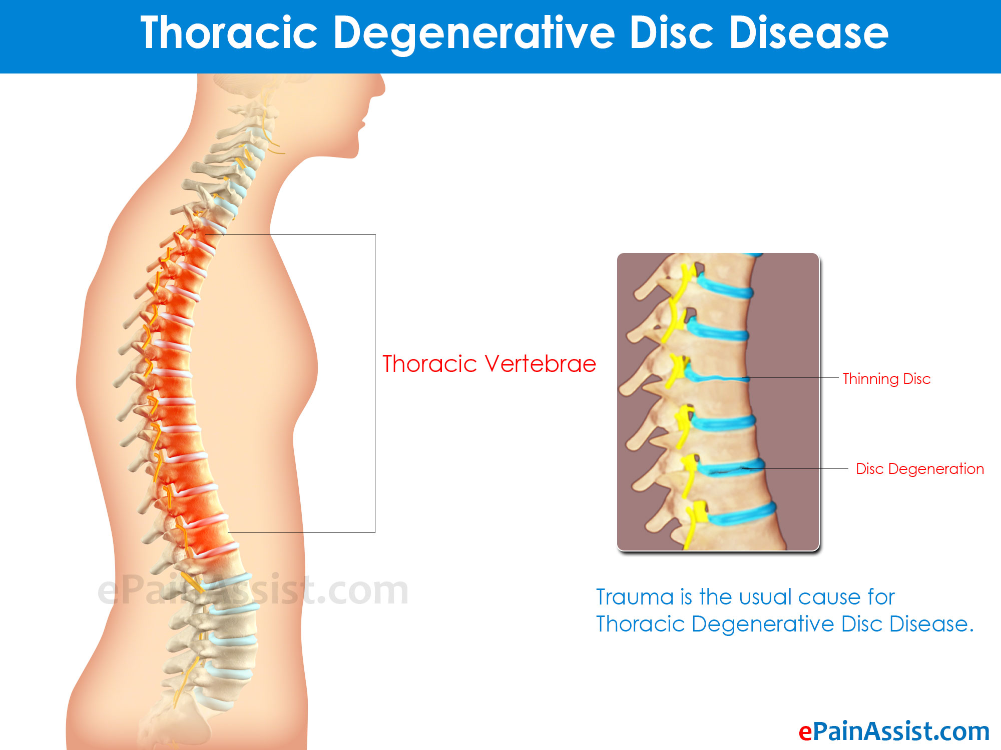 Types of Degenerative Disc Disease