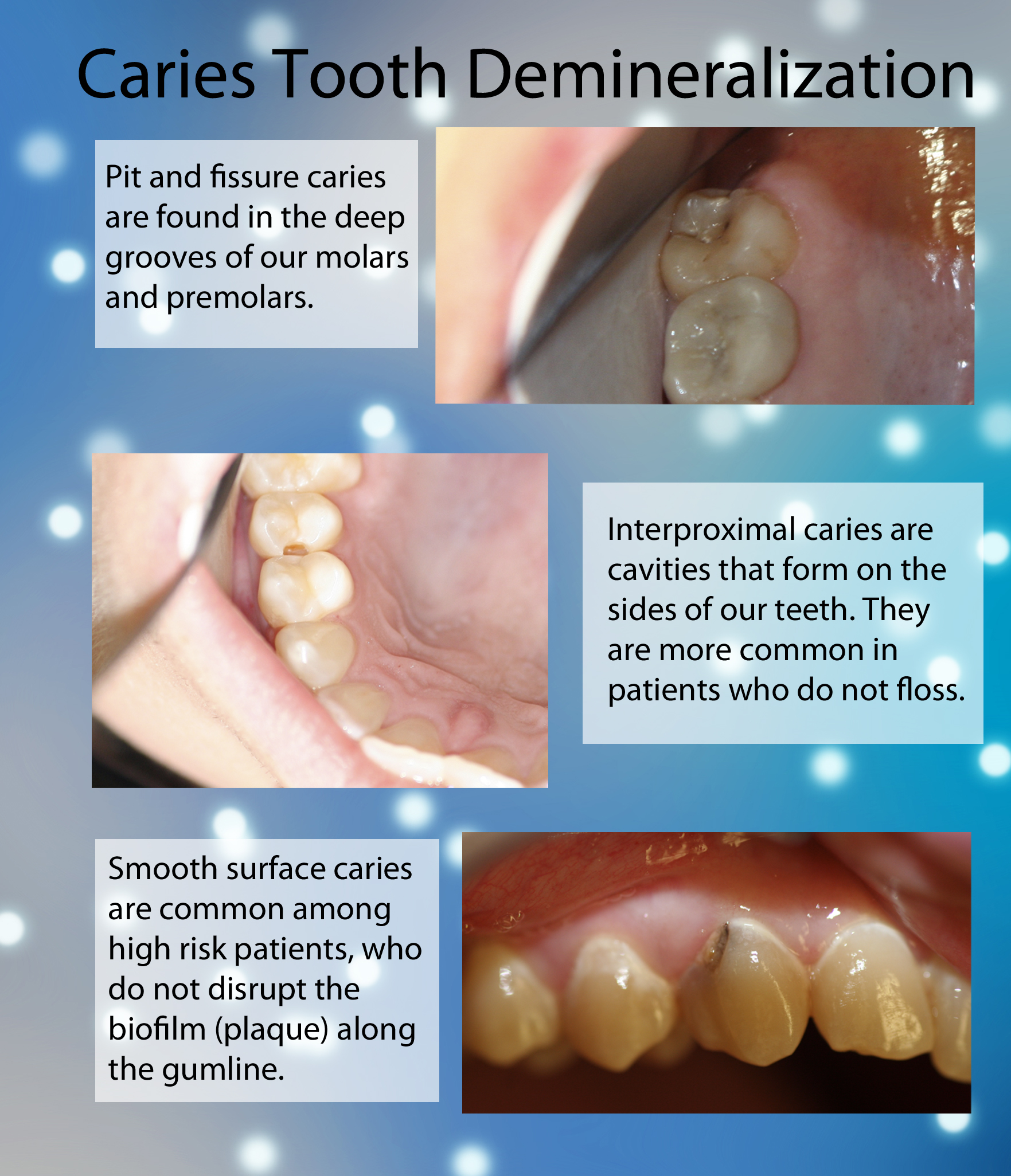 Caries & Tooth Demineralization