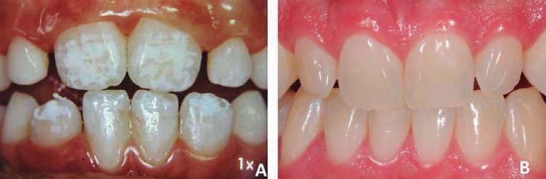 A: A 9-year-old boy with white enamel demineralization staining of six  incisors; B: Twenty years after removal of the white stains on the  maxillary central